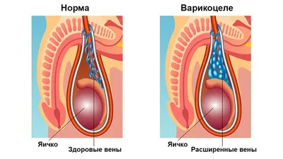 Рентгенэндоваскулярная эмболизация варикоцеле в клинике TERVE в Красноярске  - Сеть медицинских центров TERVE