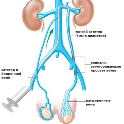 Варикоцеле: хирургическая коррекция - клиника Уросвит