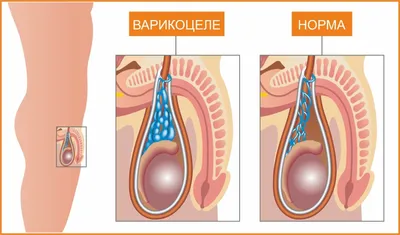 Варикоцеле: причины, симптомы и лечение в Клинике АльтраВита
