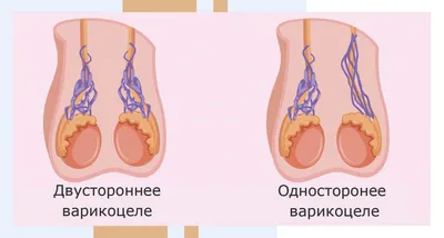 Что делать при варикоцеле? Нужно ли оперировать? ⋮ Медицинский центр  MEDICAL PLAZA