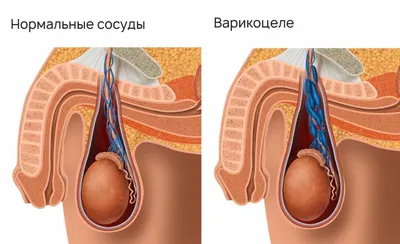 Варикоцеле у мужчин - причины, симптомы, диагностика и лечения в ИСЦ