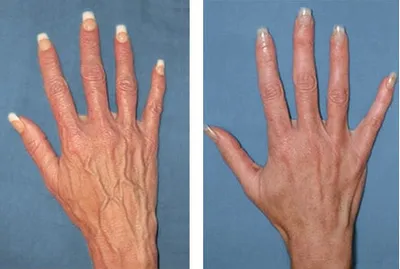 Склеротерапия (склерозирование) расширенных и неэстетичных вен на руках