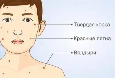 Ветрянка. Как лечить болезнь и как защититься от нее? |  |  Дзен