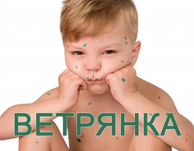 Ветряная оспа или ветрянка