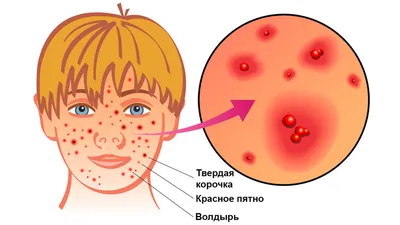 Ветрянка - Кошева Диана Мурзабековна