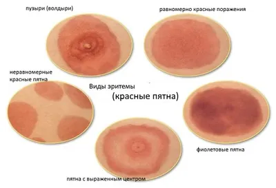 Какие продукты вызывают аллергию чаще всего? Врач-иммунолог назвала 8 групп  продуктов - Чемпионат