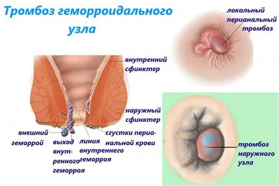 Симптомы и стадии геморроя, внутренний и внешний геморрой – причины и  лечение заболевания. | ЦМ «Глобал клиник» - услуги в области проктологии,  урологии, гинекологии, УЗИ и лабораторной диагностики в Нижнем Новгороде