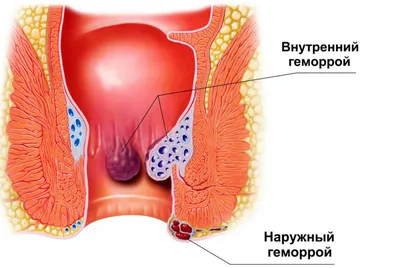 Эффективное лечение геморроя в медицинском центре | Клиника Частная  врачебная практика в Челябинске