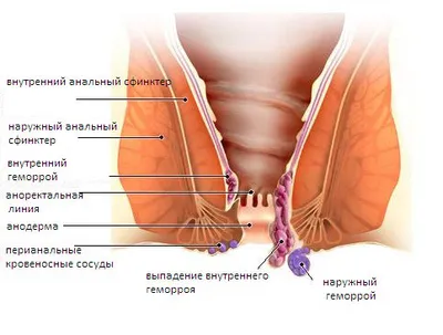 Геморрой — Википедия