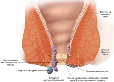Что такое геморроидальные узлы? Причины, симптомы и лечение