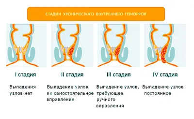 Клиническая классификация геморроя - стадии по степеням