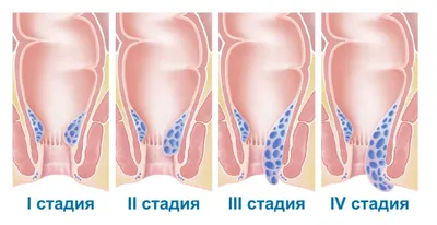 Геморрой - что это, симптомы заболевания, диагностика и лечение