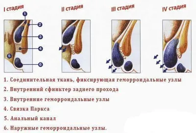 Лечение геморроя в Москве: симптомы, причины, виды, профилактика и методы  воздействия