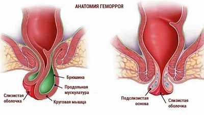 Наружный и внутренний геморрой. Операция и другие методы лечения.