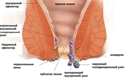 Геморрой у женщин: причины, симптомы, признаки, что делать, как избавиться,  лечение