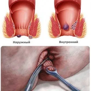 Геморрой: виды, стадии, лечение - Клиника Доктора Гришина