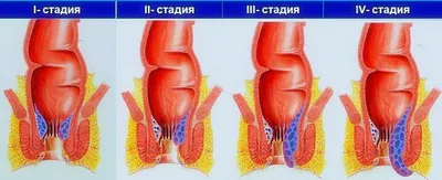 Лечение геморроя - Медицинский Центр "Седьмое Небо"