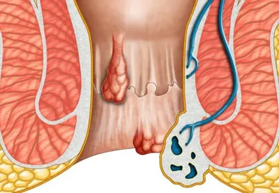 Лечение геморроя - Медицинский центр "Мирт"