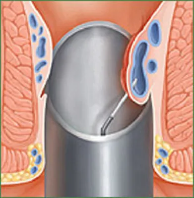 Геморрой: виды, стадии, лечение