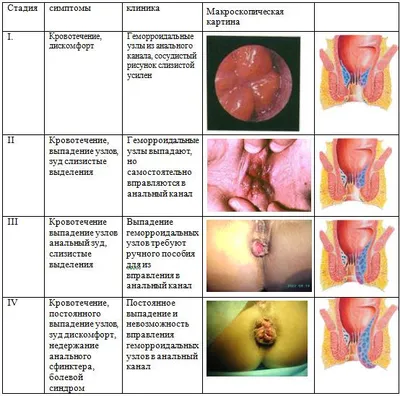 Геморрой - симптомы, диагностика и лечение в Шахтах