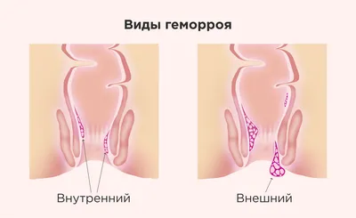 Геморрой первой стадии (степени): современные подходы к лечению и  профилактике