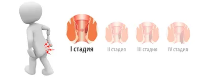 Лечение внешнего(наружного) геморроя в СПб - цены, отзывы, фото