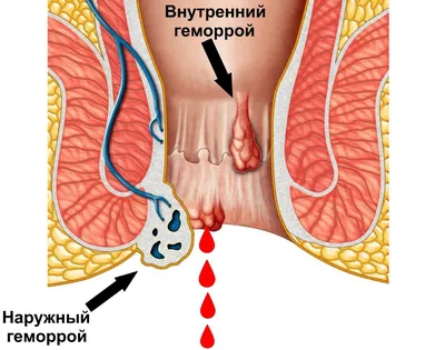 Виды Геморроя — стоковая векторная графика и другие изображения на тему  Геморрой - Геморрой, Анус, Фистула - iStock