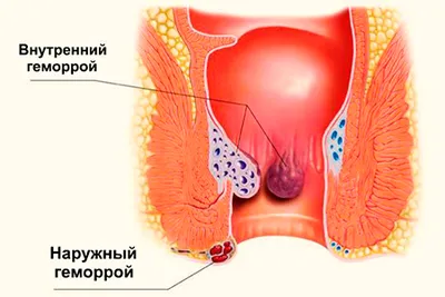 Геморрой: что такое? Как бороться? - статьи от компании Еламед