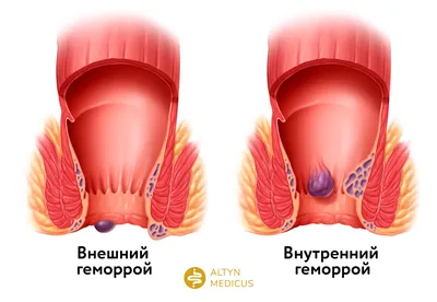 Геморрой - симптомы, лечение, причины и профилактика геморроя - Гармония