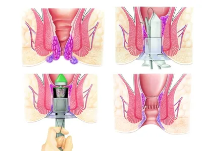 Лечение геморроя без операции методом катетеризации - ENDORAD