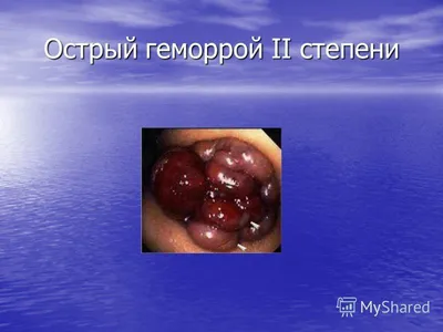 Лечение геморроя современными методами в Москве