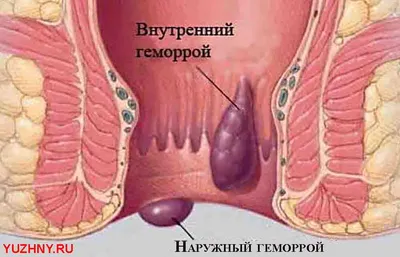 Геморрой – вылечить в Онли Клиник быстро и эффективно!