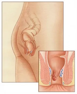 Классификация и типы геморроя Киев, Печерск | "МедЦентрСервис"