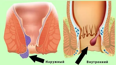 Геморрой - симптомы, лечение, причины и профилактика геморроя - Гармония