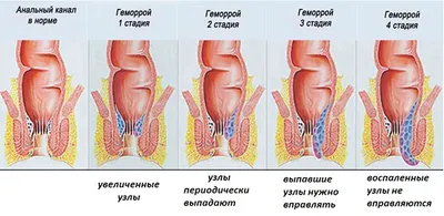 Лечение геморроя - Медицинский Центр "Седьмое Небо"