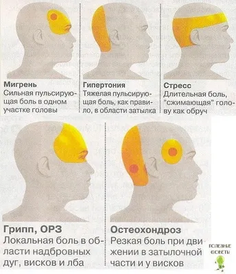 Виды головных болей | Всё о Медицине | Дзен