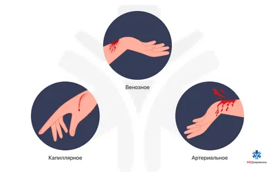 Оказание первой помощи при кровотечениях: правила наложения жгута