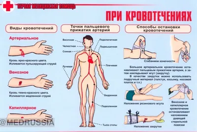 Купить постер (плакат) Способы временной остановки кровотечений