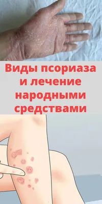 ᐈ Лечение псориаза 【Левый Берег】 Киев ~ Цены
