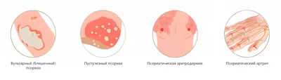 Псориаз — причины возникновения, методы лечения и профилактики – Семейная  клиника «Доктор АННА»