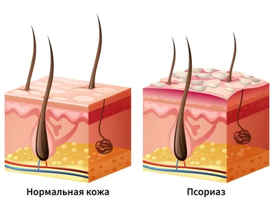 Клинические особенности псориаза у детей и подростков