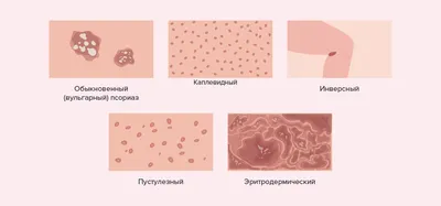 Псориаз: симптомы, виды и лечение