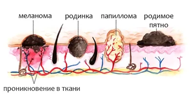 Опасные родинки фото, как выявить скинчек от врача - 