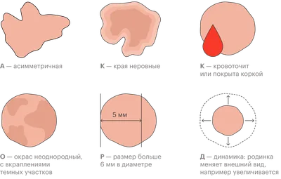 Как вовремя распознать опасные родинки? | МЦ Промедклиник