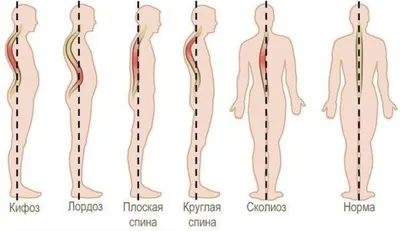 Признаки сколиоза, симптомы, виды, лечение