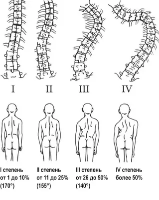 Сколиоз: виды, причины, лечение - KinesioPro