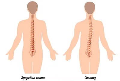 Особенности правостороннего и левостороннего сколиоза. Доктор Позвонков