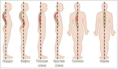 Сколиоз