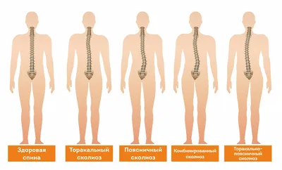 Что же такое сколиоз?и как выбрать корсет? | Наш канал. | Дзен