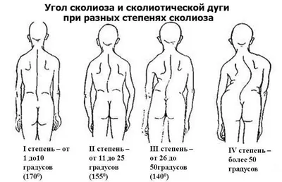Лечение сколиоза в Киеве: цена на лечение сколиоза в ортопедии в клинике  Оксфорд Медикал